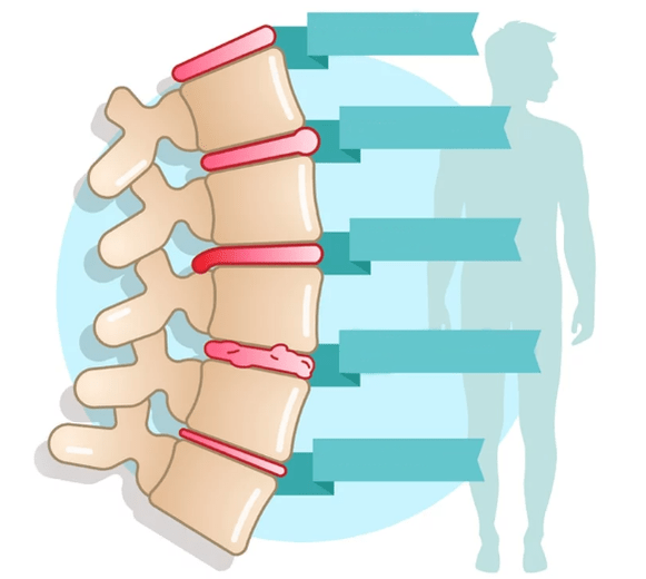 Grado de enfermedad de la osteocondrosis del tórax
