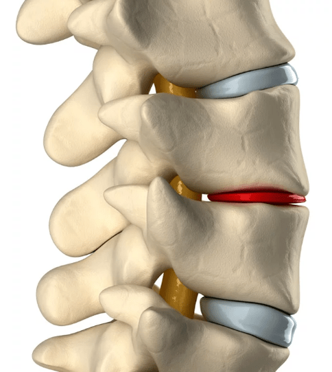 Osteocondrosis de la columna torácica
