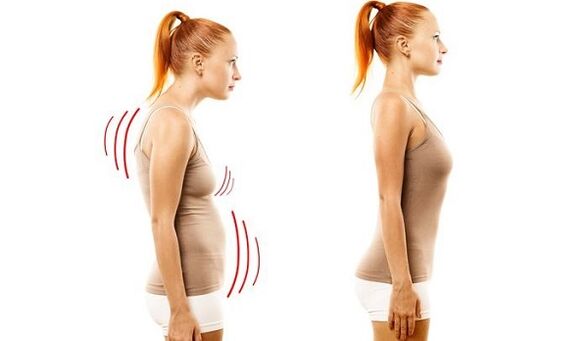 espalda recta y mala postura con osteocondrosis cervical