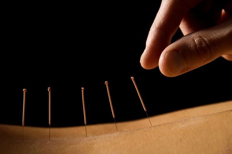 Acupuntura para el dolor lumbar.