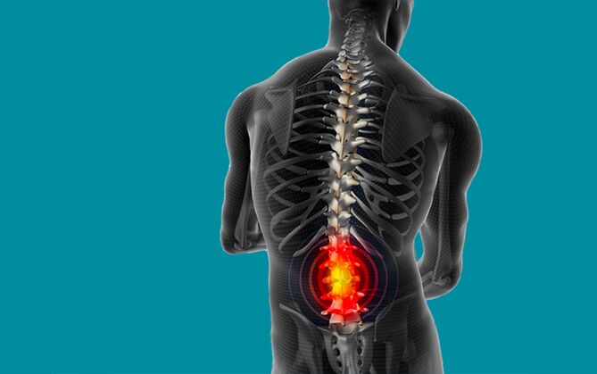 Dolor de espalda en la región lumbar.