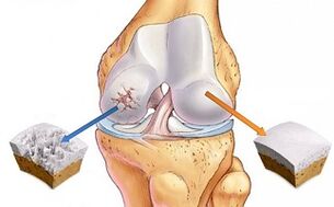 cartílago sano y osteoartritis de la articulación de la rodilla